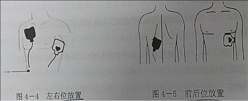 除颤电极选购指南(图2) 除颤电极选购指南(图2)